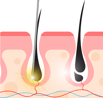 Electrolysis Permanent Choice Permanent Choice Laser Hair